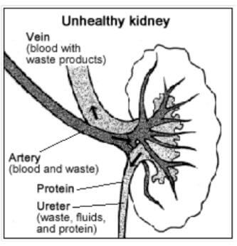 Unhealthy kidney, dialysis treatment, kidney failure